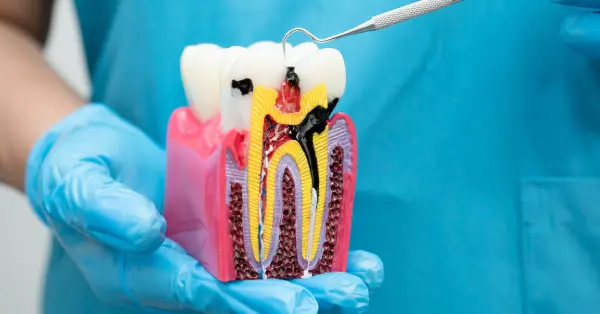 5 Post-Root Canal Tips from an Endodontist in San Francisco