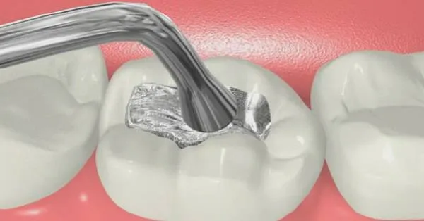 5 Signs You May Require a Teeth Filling in San Francisco