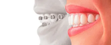 Best Alternatives to Braces | Invisalign San Francisco, CA
