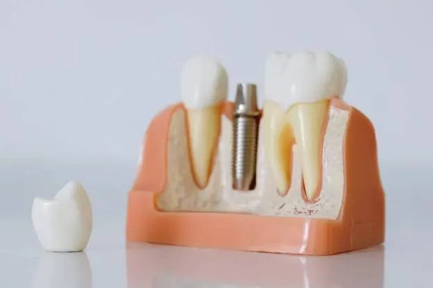 Choosing the Right Treatment for Your Damaged Tooth: Endodontic Therapy or Dental Implants?