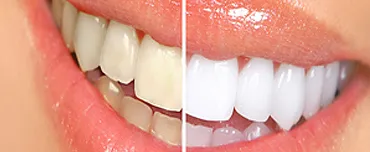 Teeth Whitening Offered By Cosmetic Dentist | San Francisco