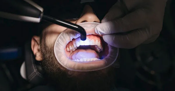 Things You Should Know Before Getting a Tooth Filling in San Francisco