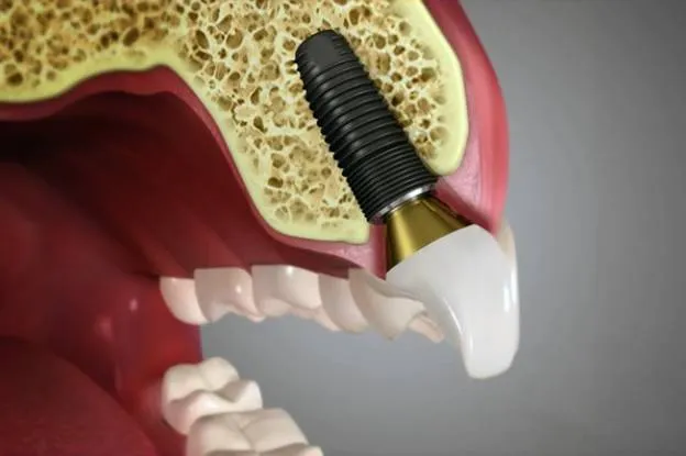 Top 5 Benefits of Dental Implants That You Need to Know	