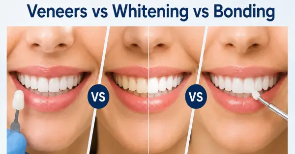 Veneers vs Whitening vs Bonding: SF Smile Guide Helpful dental information about cosmetic dentistry in San Francisco