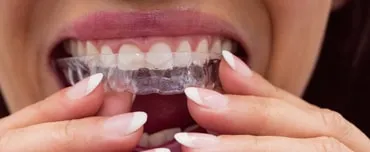 Invisalign Promises Big Smiles