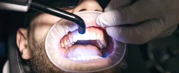 Why Professional Teeth Whitening Important? | San Francisco