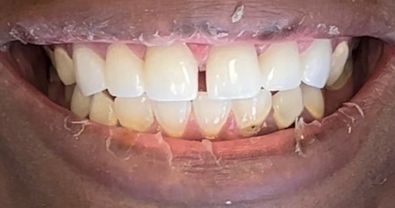 Smile after treatment, case 1