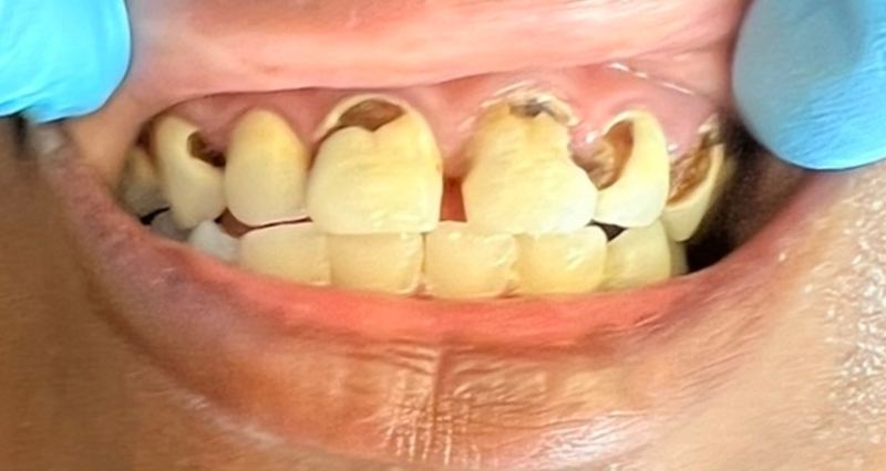 Smile before treatment, case 1