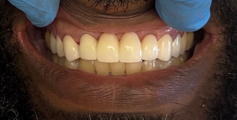 Smile after treatment, case 2
