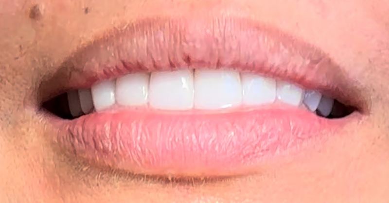 Smile after treatment, case 3