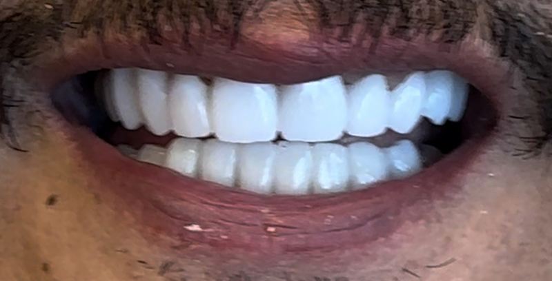 Smile after treatment, case 4
