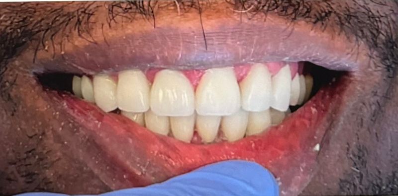 Smile after treatment, case 5