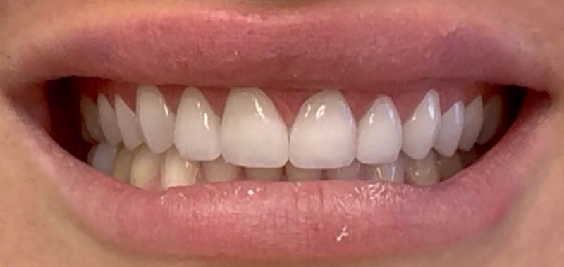 Smile after treatment, case 7
