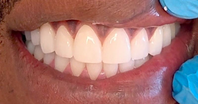 Smile after treatment, case 8