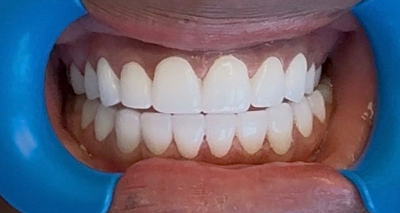 Smile after treatment, case 9