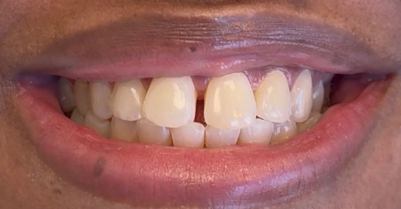 Smile before treatment, case 9