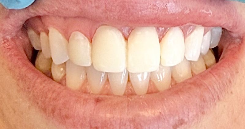 Smile after treatment, case 10