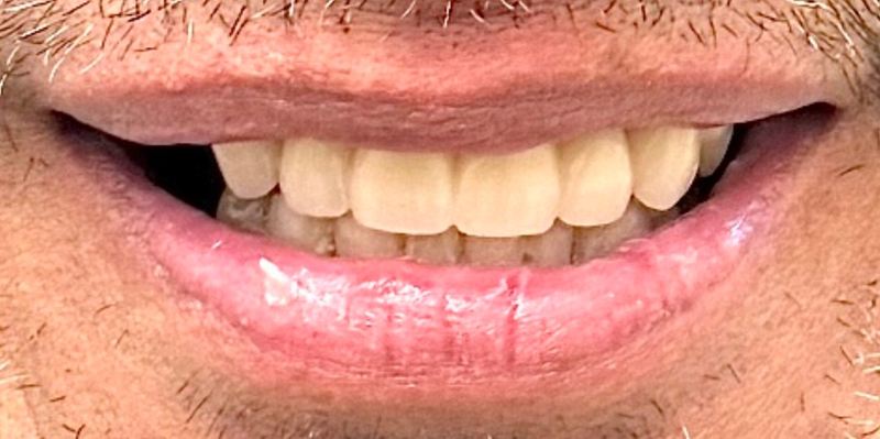 Smile after treatment, case 11