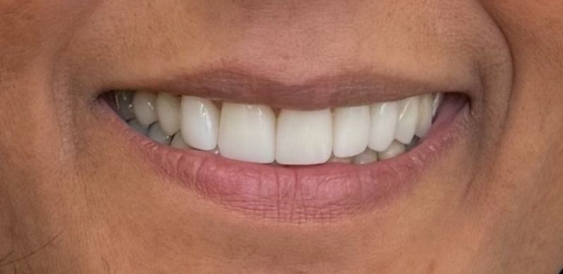 Smile after treatment, case 12