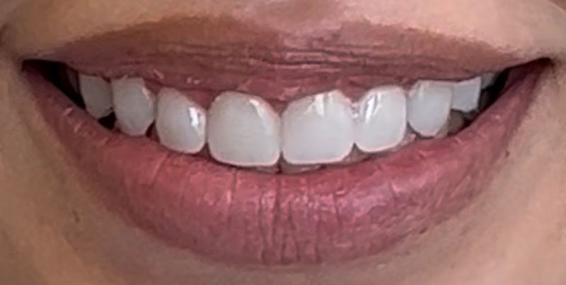Smile after treatment, case 13