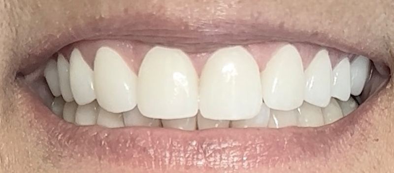 Smile after treatment, case 14