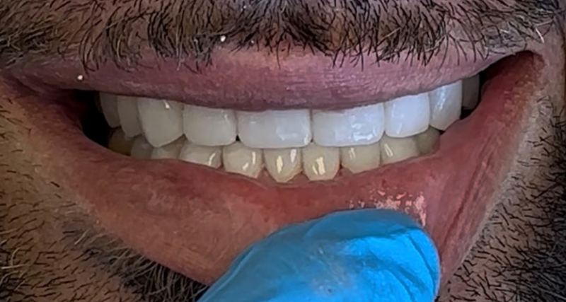 Smile after treatment, case 15