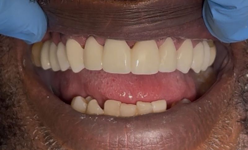 Smile after treatment, case 16