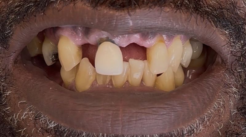 Smile before treatment, case 16