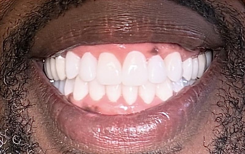 Smile after treatment, case 17