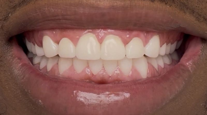 Smile after treatment, case 18