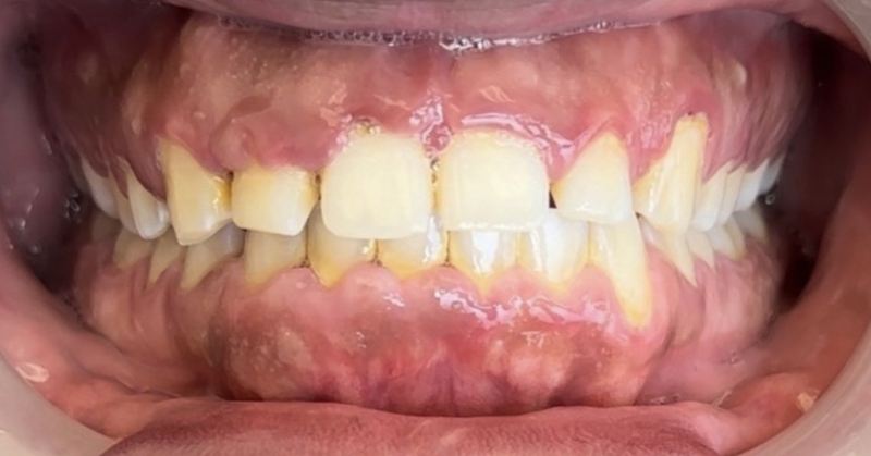 Smile before treatment, case 18