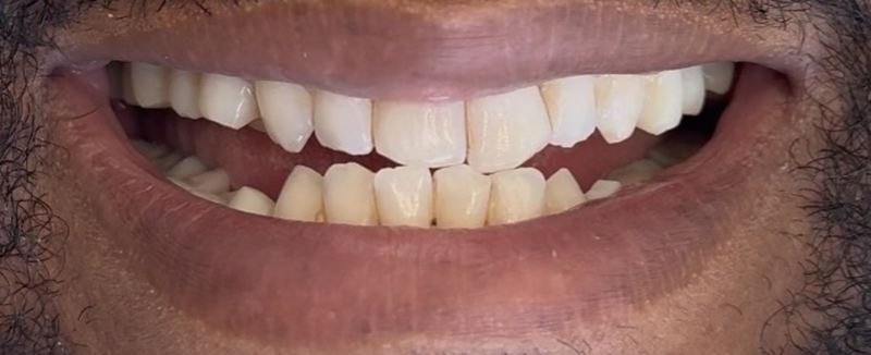 Smile before treatment, case 19