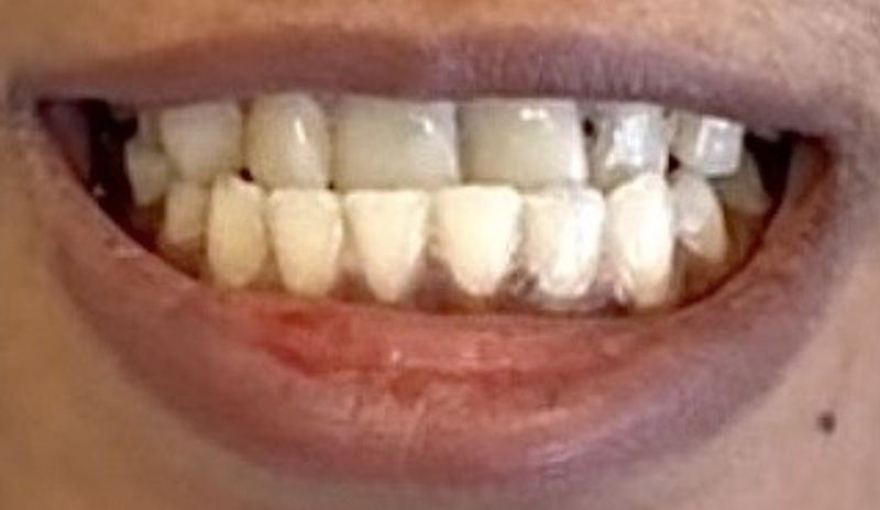 Smile before treatment, case 20