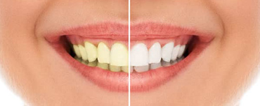 Teeth Whitening San Francisco